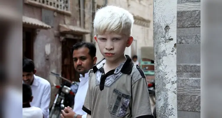 Inédito censo de albinos para saber cuántos son en Chile