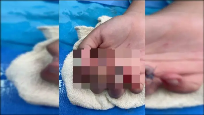 Niña de 11 años resulta con su dedo mutilado tras accidente en supermercado de Curicó
